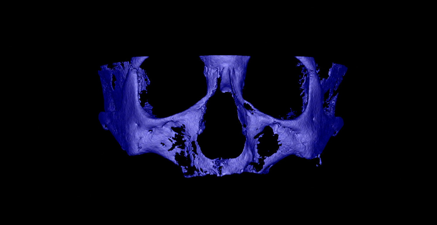 Reconstrução tomográfica 3D da maxila atrófica